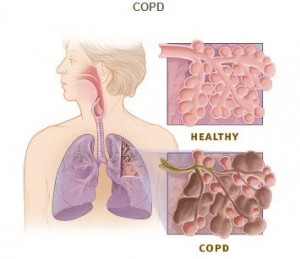 COPD