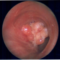 rare-lung-tumor