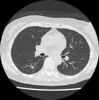 stage-zero-lung-cancer