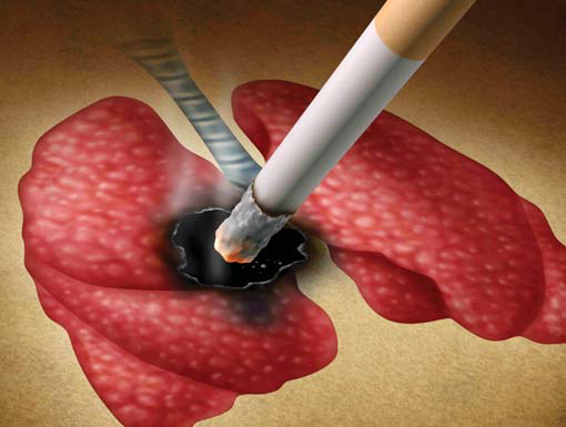 lung_cancer