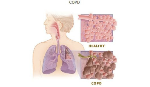 Chronic Obstructive Pulmonary Disease: Symptoms, causes, diagnosis, and treatment