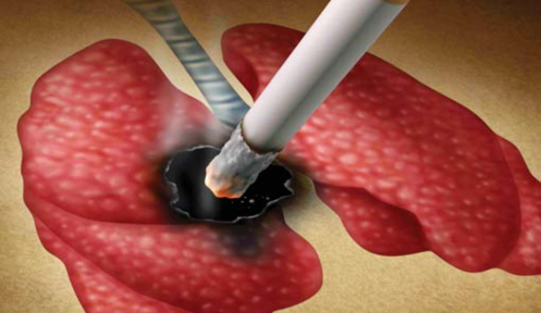 Smoking and lung cancer