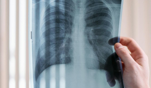 Should I Be Worried About Lung Nodules?