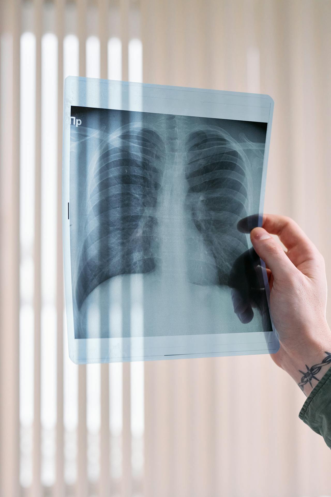Should I Be Worried About Lung Nodules?