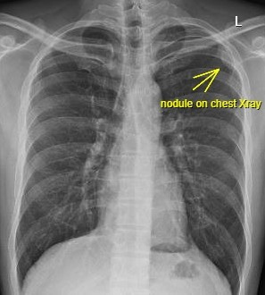 case11