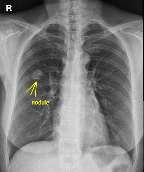 case11