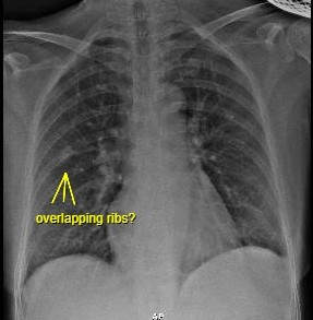 case11