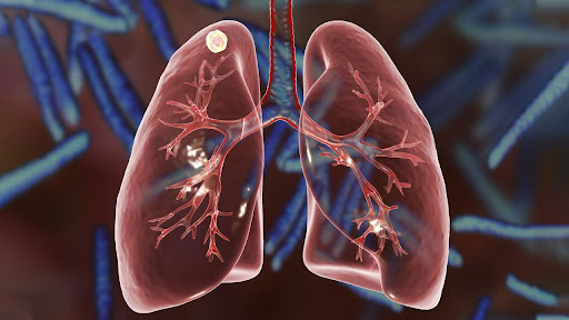 What Is a Lung Nodule? Symptoms, Causes, and When You Should Worry